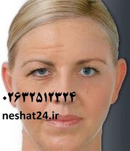 تزریق بوتاکس