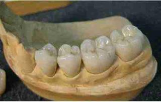 پروتزهای اندامی 