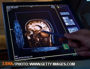 تومورهای مغزی را بیشتر بشناسیم 